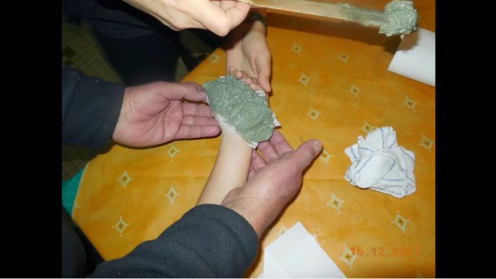 小男孩的手掌「慘遭嚴重燙傷」，醫生卻拒醫，媽媽竟用了「它」…45天後完全康復，還不留疤痕