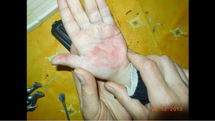 小男孩的手掌「慘遭嚴重燙傷」，醫生卻拒醫，媽媽竟用了「它」…45天後完全康復，還不留疤痕