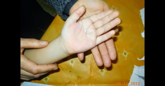小男孩的手掌「慘遭嚴重燙傷」，醫生卻拒醫，媽媽竟用了「它」…45天後完全康復，還不留疤痕