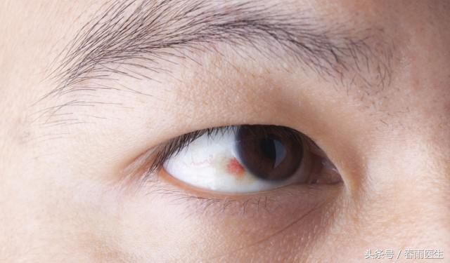 眼睛有紅血絲，好好休息就行了？不是！出現這7個症狀需就醫