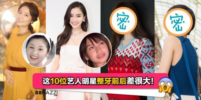 【戴完牙套後大變臉！】這明星沒矯正牙齒之前原來長這樣！網友：牙齒真的很重要啊！