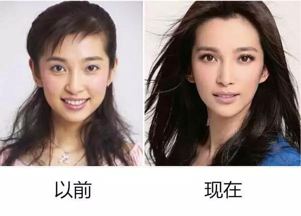 【戴完牙套後大變臉！】這明星沒矯正牙齒之前原來長這樣！網友：牙齒真的很重要啊！
