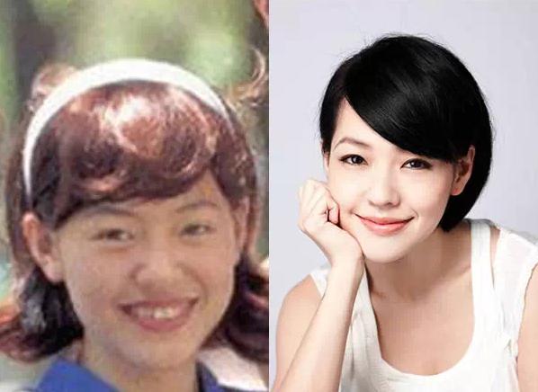 【戴完牙套後大變臉！】這明星沒矯正牙齒之前原來長這樣！網友：牙齒真的很重要啊！