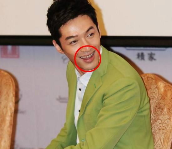 【戴完牙套後大變臉！】這明星沒矯正牙齒之前原來長這樣！網友：牙齒真的很重要啊！