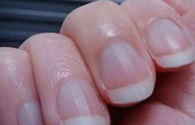 指甲上凸起一條條豎線千萬不可大意，簡單的食療法，為你解困擾