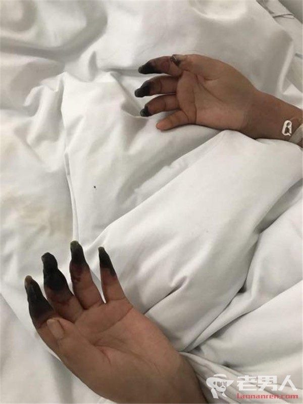 震驚！婦人打掃完家裡「8根指頭焦黑」慘變枯枝！連醫生也搖頭嘆：她太粗心了......