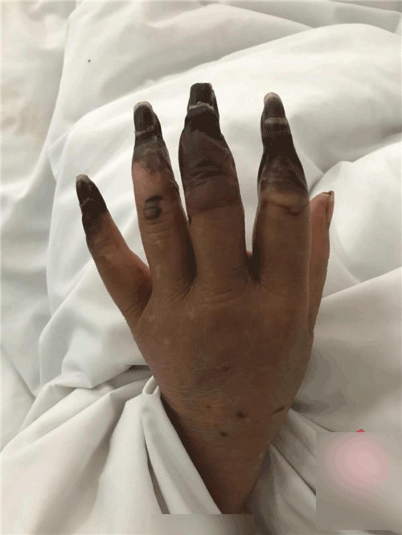 震驚！婦人打掃完家裡「8根指頭焦黑」慘變枯枝！連醫生也搖頭嘆：她太粗心了......