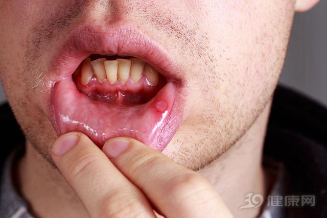 快速趕走「口腔潰瘍」的5種方法，每次用都覺得神奇！