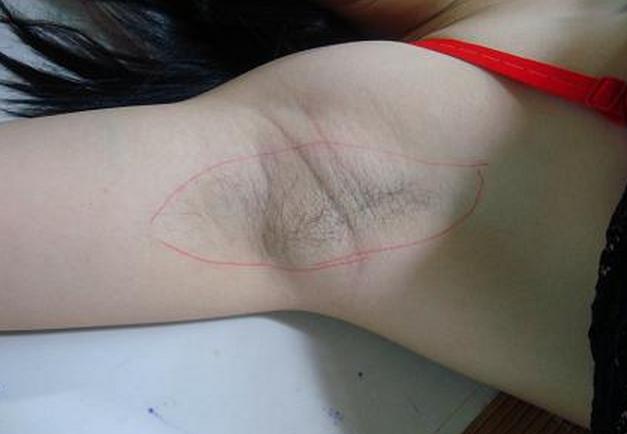 如何擺脫腋下黑色素？這招簡單有效