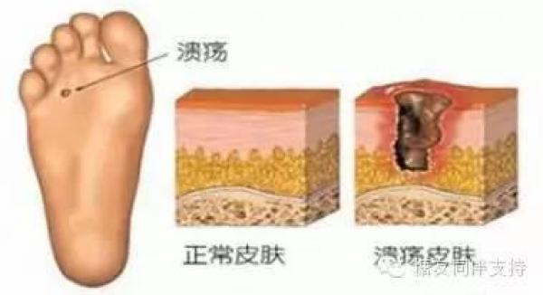 注意！他患「糖尿病」20多年，定期到醫院打胰島素，腳還是發黑腐爛！原因竟然是?!天啊！一定要分享出去！