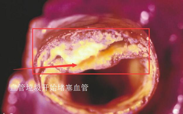 腦梗被堵，多喝1種水，掃光血管垃圾，低密度脂蛋白也下去了
