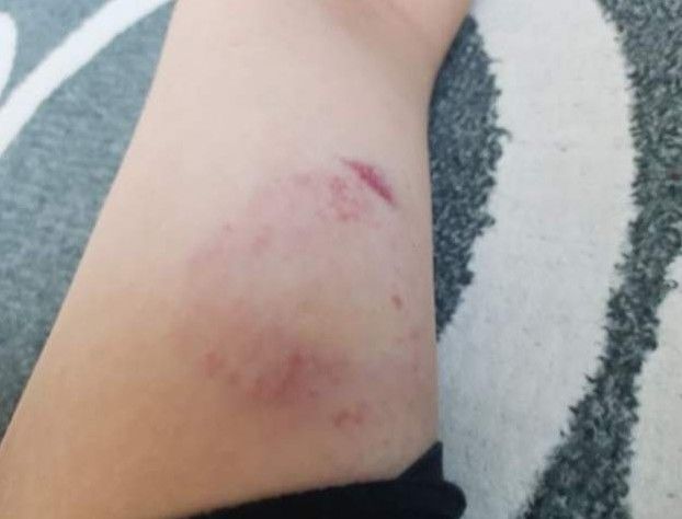 「我被殭屍咬了？」...被女友咬一口後 傷口竟越來越嚴重？ 男po網求救：這很毒！