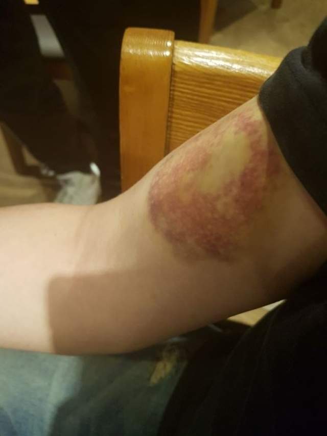 「我被殭屍咬了？」...被女友咬一口後 傷口竟越來越嚴重？ 男po網求救：這很毒！