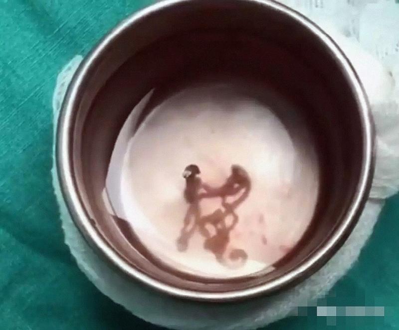 醫生從男子腦幹活捉30厘米長白蟲 只因為他吃了這種食物