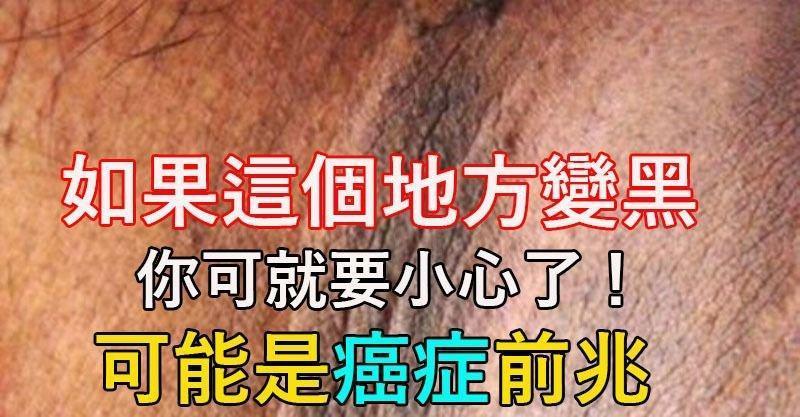 如果發現身體『這 個 地 方』變黑，可能是癌症症狀…為了健康一定要學會看！ 