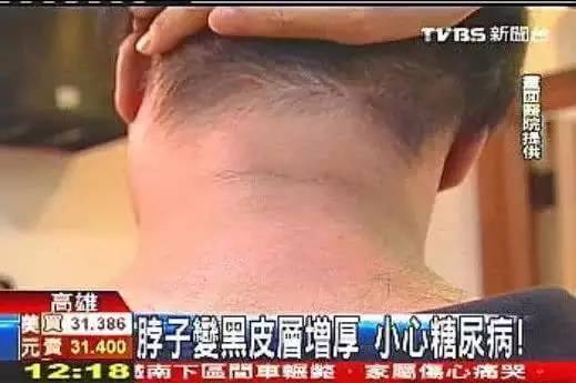 如果發現身體『這 個 地 方』變黑，可能是癌症症狀…為了健康一定要學會看！ 