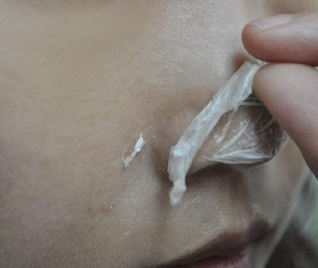 鼻子上難看的（小顆粒），教你三招強力去除，一周之後皮膚細膩似牛奶！歡迎分享！ 