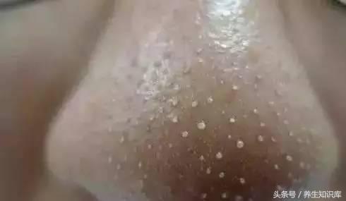 鼻子上難看的（小顆粒），教你三招強力去除，一周之後皮膚細膩似牛奶！歡迎分享！ 