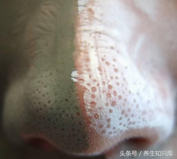 鼻子上難看的（小顆粒），教你三招強力去除，一周之後皮膚細膩似牛奶！歡迎分享！ 