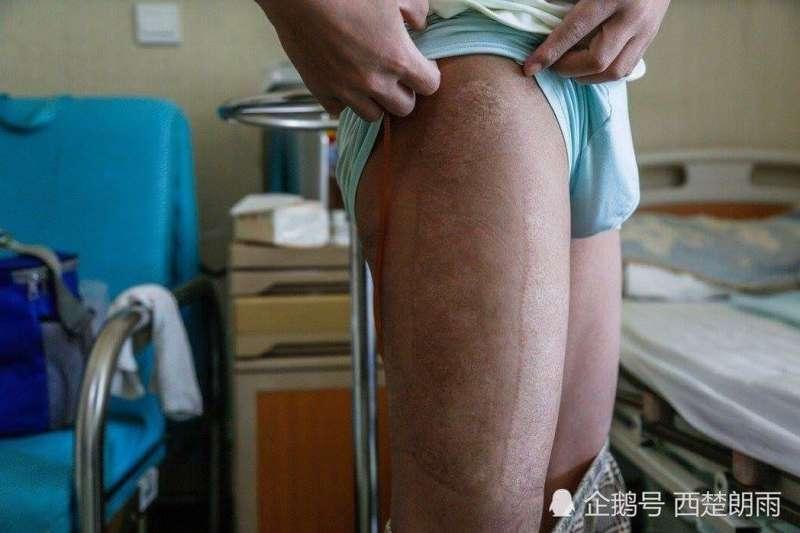 帥教官罹血癌「皮膚潰爛」遭現任拋棄　絕望之際前女友突然現身醫院… 