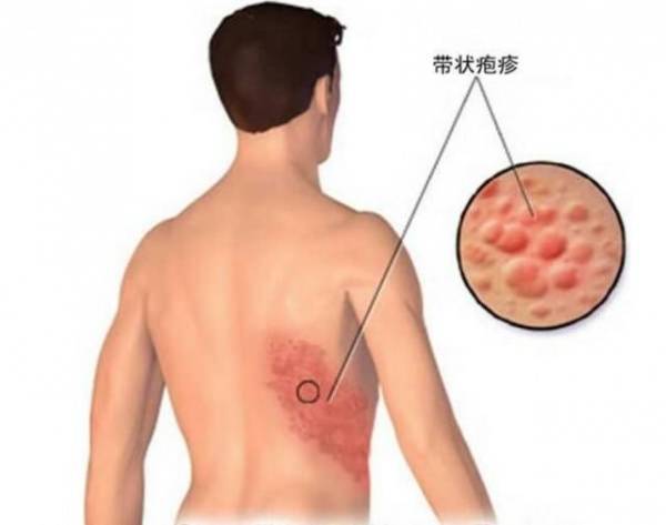 被「皮蛇」繞一圈，你就可能沒救了？！只要跟著奶奶「泡這一杯茶」，立馬就能減輕疼痛！ 