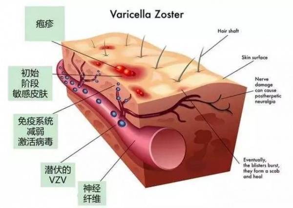 被「皮蛇」繞一圈，你就可能沒救了？！只要跟著奶奶「泡這一杯茶」，立馬就能減輕疼痛！ 