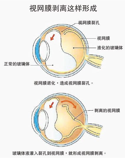 黃斑部病變可致眼瞎·注射藥物搶救視覺