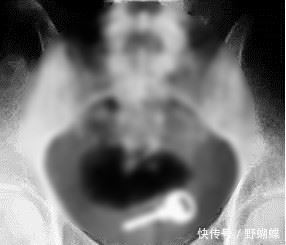 17歲女孩當伴娘，一個月後下身出血，醫生手術後取出「異物」！