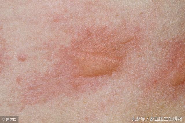 蕁麻疹是由什麼引起的？這4個「禍首」，哪個都別小看 