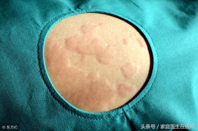 蕁麻疹是由什麼引起的？這4個「禍首」，哪個都別小看 
