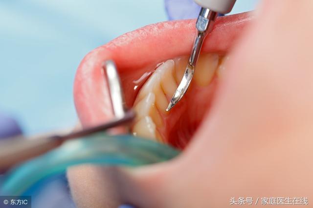 口腔里有牙結石，對人體有哪些危害？主要有3個