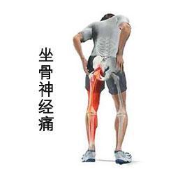 「坐骨神經痛」屁股痛到腳，傳授六個習慣四個操，一個禮拜後整個不一樣！ 