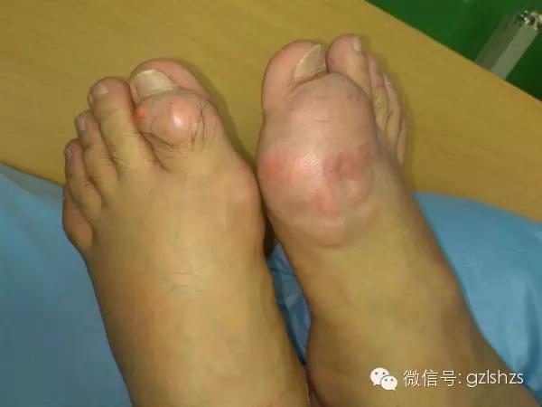 如何「避免痛風」終於有解！方法居然出乎意料的簡單，人人都能做到！ 