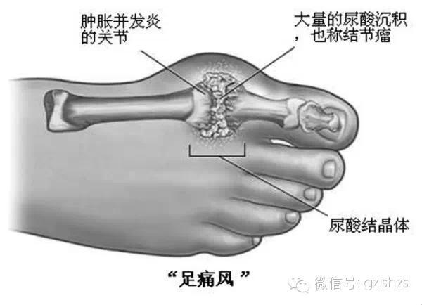 如何「避免痛風」終於有解！方法居然出乎意料的簡單，人人都能做到！ 