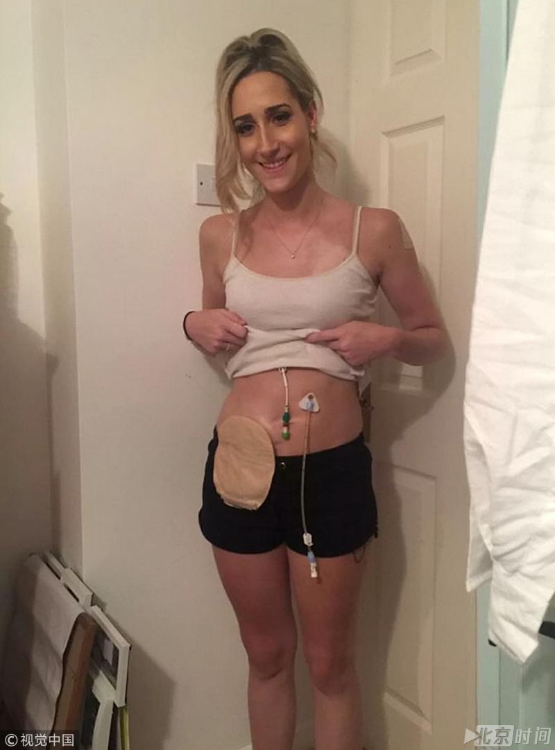 英國23歲女子，自出生起腸子外露，每天靠注射藥品活命！