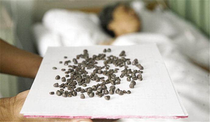 60歲婆婆痛到不能坐不能站，去醫院醫生都嚇一跳，身體塞滿幾百顆石頭！這種食物儘量不要吃了