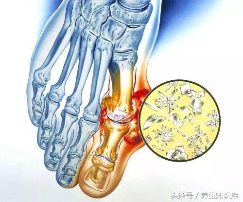 尿酸高，不僅會誘發痛風，還有這4大潛伏危害，切莫忽視！