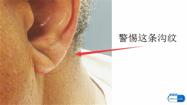 年過35歲的你，耳朵是否也有出現「這條溝」？！有的話就要注意了！要立馬到醫院去檢查！
