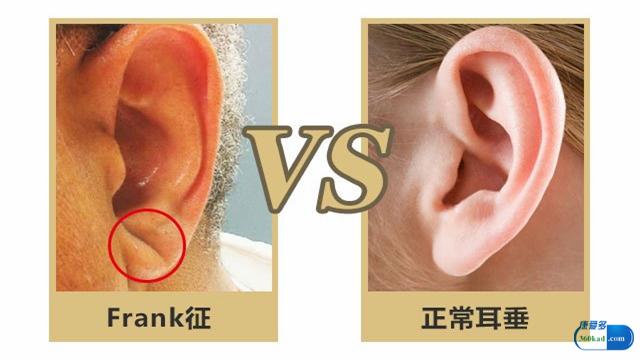 年過35歲的你，耳朵是否也有出現「這條溝」？！有的話就要注意了！要立馬到醫院去檢查！