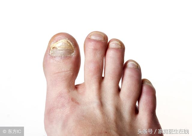 如果一直不治療灰指甲，對人有什麼影響？