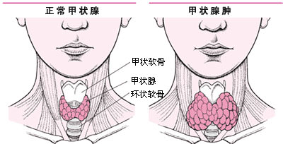 注意！「甲狀腺腫大」都是自己吃出來的! 七種食物越吃「脖子越腫」，最好別吃了！