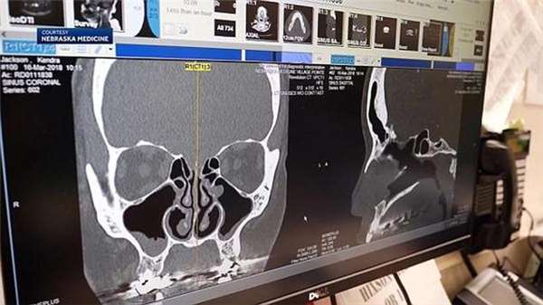 她流了5年鼻涕從不間斷，近期赫然發現這居然不是鼻涕而是腦液！