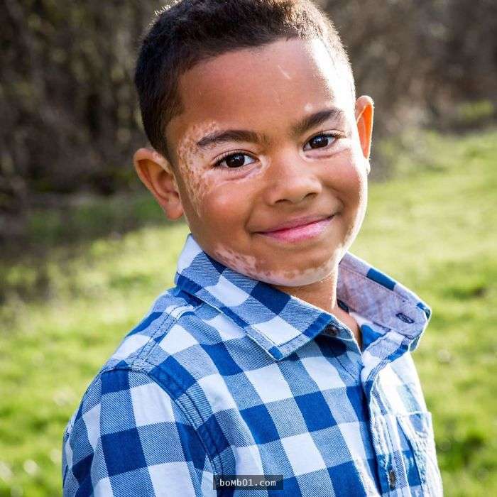 天生有白斑病的8歲男孩從小就「很討厭自己的臉」，直到他遇見了「狗狗版自己」…生命就徹底被改變了！ 