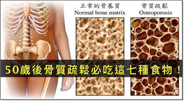 50歲後骨質...預防骨質疏鬆必吃「七種高鈣食物」：專補骨頭空洞，輕鬆恢復好骨力！