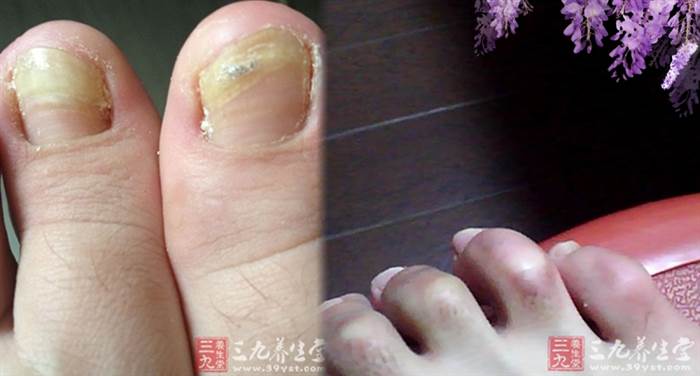 如果你的腳趾是這樣的, 有患癌風險, 一定得仔細看!！千萬別猶豫請趕緊去醫院做檢查！ !