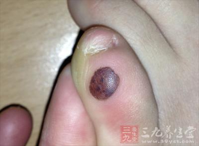 如果你的腳趾是這樣的, 有患癌風險, 一定得仔細看!！千萬別猶豫請趕緊去醫院做檢查！ !