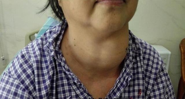 脖子上出現這3種情況，可能是癌症前兆，快看一看、摸一摸