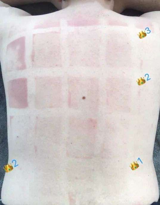 人肉實測15品牌防曬效果　背後曬出「烤肉架」找出第一名