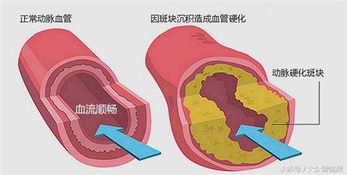 中醫力薦：這4款降脂茶，調節血脂事半功倍