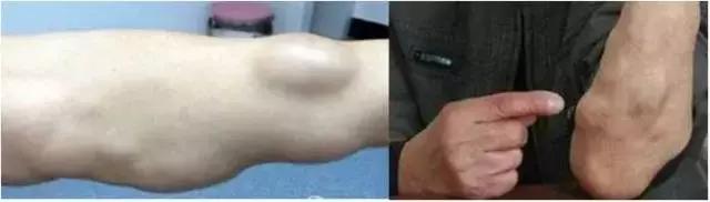 長了脂肪瘤怎麼辦？脂肪瘤會惡變嗎？